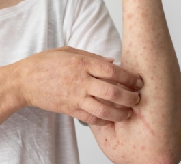 Alergia ao frio | Entenda sintomas, causas e tratamento