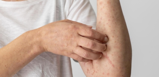 Alergia ao frio | Entenda sintomas, causas e tratamento